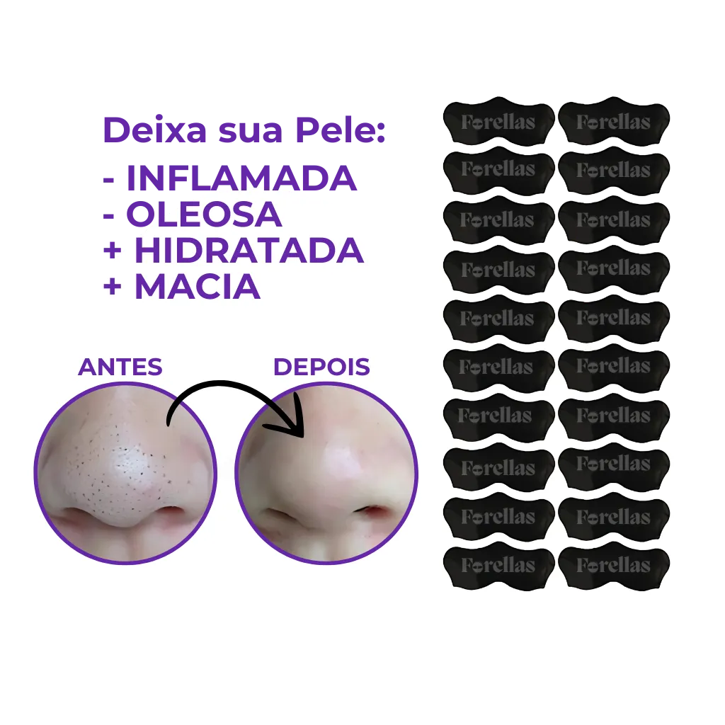 Máscara para Cravos do Nariz - Nunca Foi Tão Fácil Tirar os Cravos do Nariz!