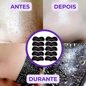 Máscara para Cravos - Elimine Cravos do Nariz sem Dor!