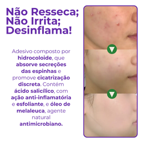 Adesivo Antiacne - Elimine Espinhas sem Marcas em 1 Dia!